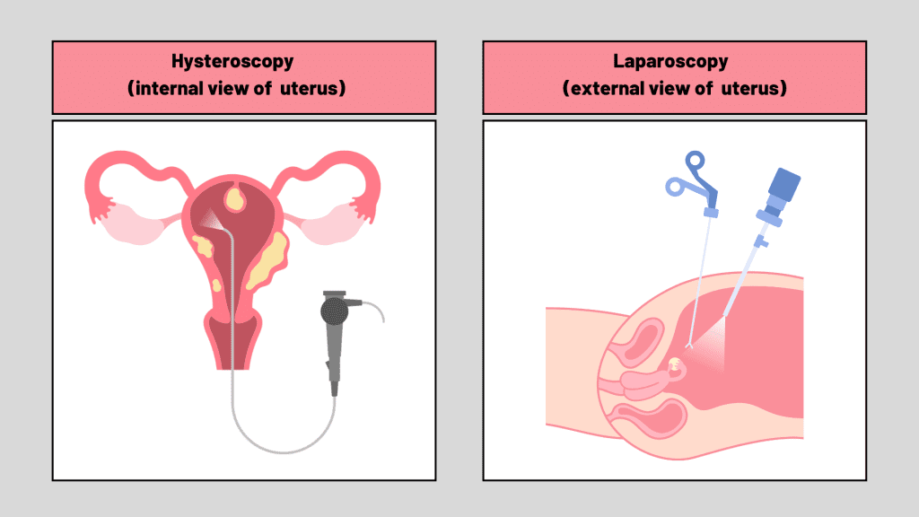 Laparoscopy vs. Hysteroscopy: Which One Do You Need?