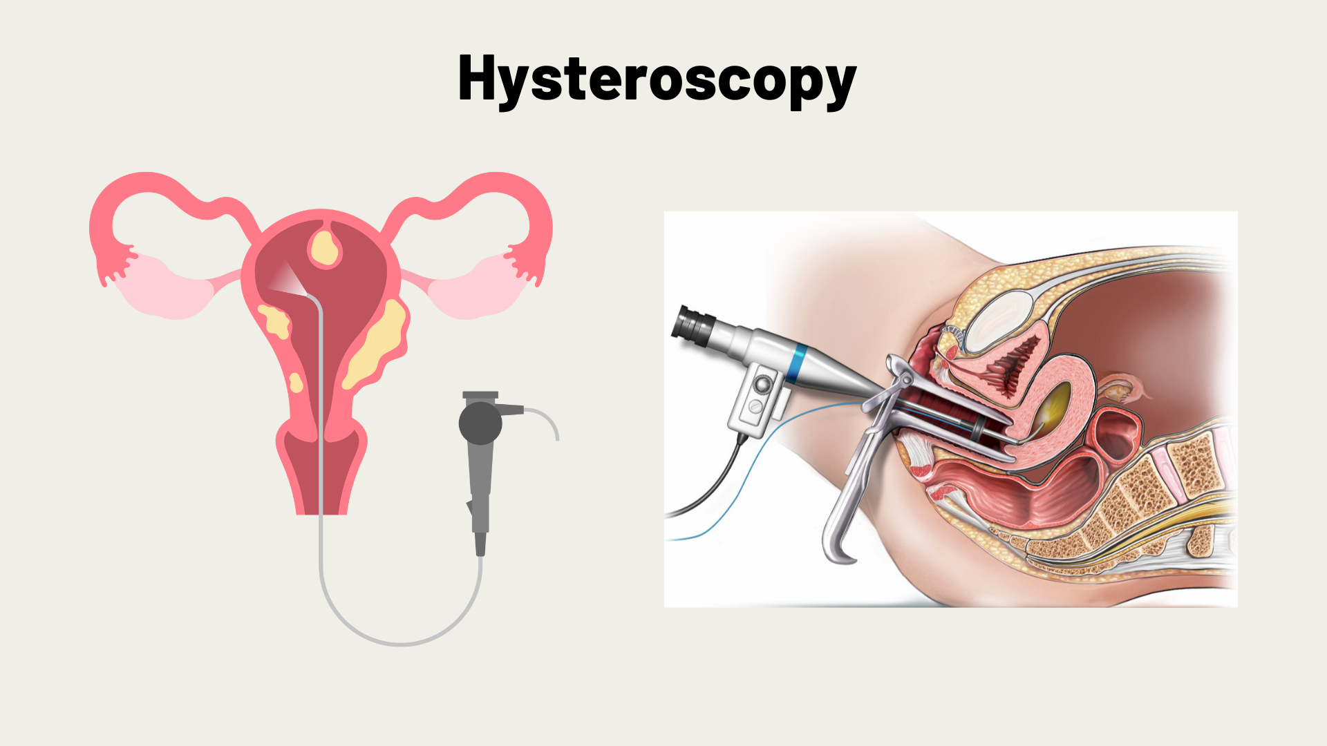 Hysteroscopy for infertility treatment in a fertility clinic