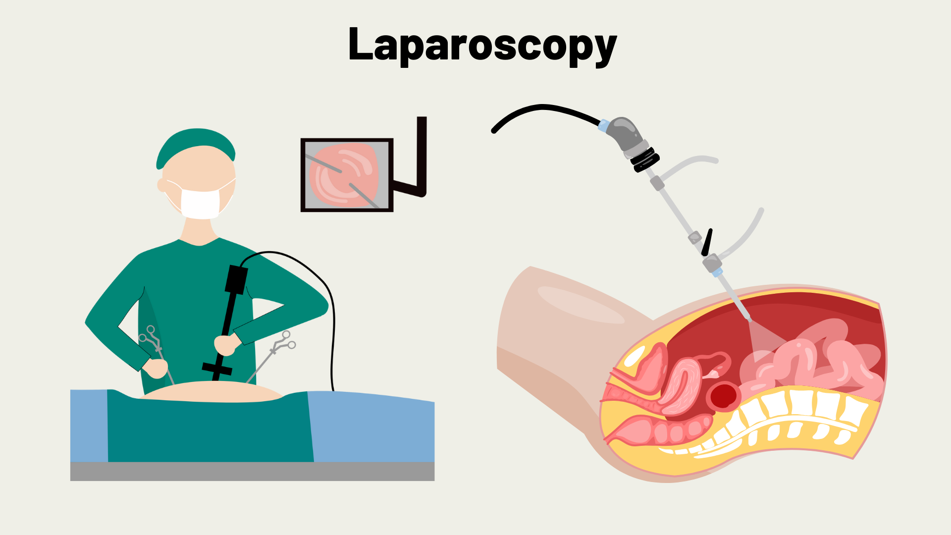 Minimal access surgery for infertility: Laparoscopy procedure